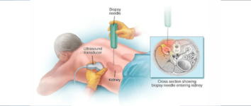 Stroke Treatment